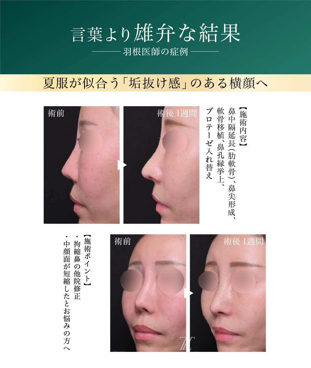 ビフォーアフター 言葉より雄弁な結果 羽根医師の症例 夏服が似合う「垢抜け感」のある横顔へ 【施術内容】鼻中隔延長（肋軟骨）、鼻尖形成、軟骨移植、鼻孔縁挙上、プロテーゼ入れ替え 【施術ポイント】・拘縮鼻の他院修正 ・中顔面が短縮したとお悩みの方へ