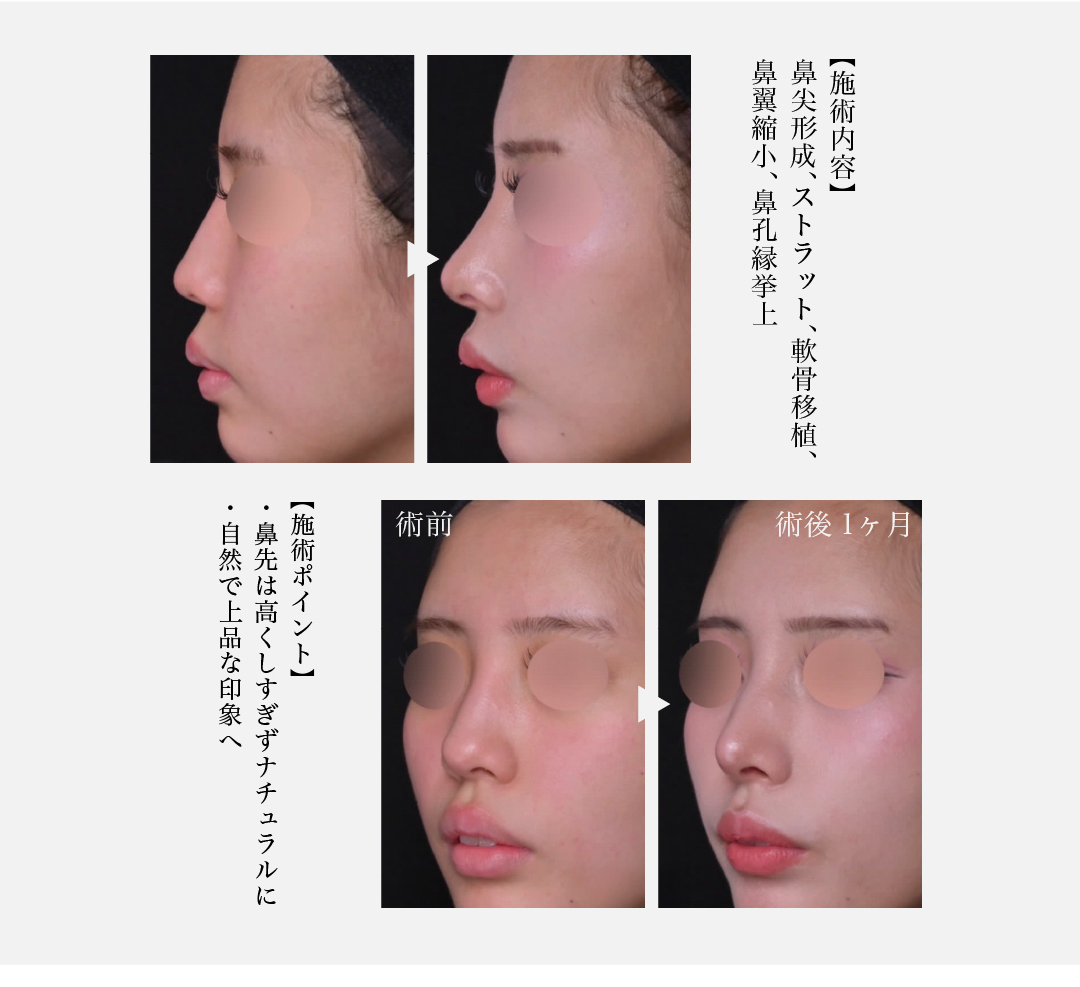 【施術内容】鼻尖形成、ストラット、軟骨移植、鼻翼縮小、鼻孔縁挙上 【施術ポイント】 ・鼻先は高くしすぎずナチュラルに ・自然で上品な印象へ