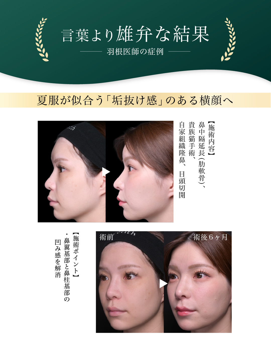 ビフォーアフター 言葉より雄弁な結果 羽根医師の症例 夏服が似合う「垢抜け感」のある横顔へ 【施術内容】鼻中隔延長（肋軟骨）、鼻尖形成、軟骨移植、鼻孔縁挙上、プロテーゼ入れ替え 【施術ポイント】・拘縮鼻の他院修正 ・中顔面が短縮したとお悩みの方へ