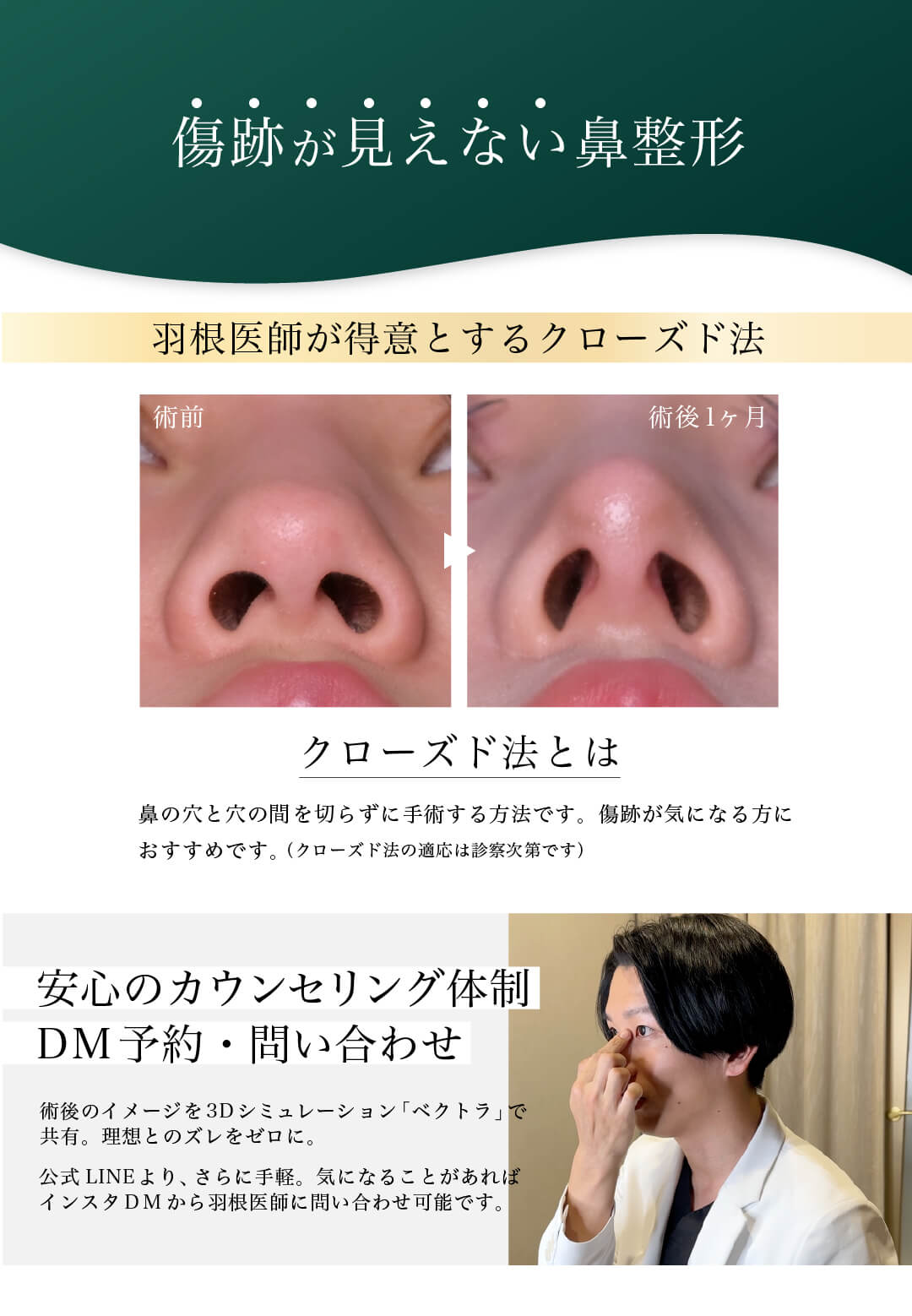 傷跡が見えない鼻整形 羽根医師が得意とするクローズド法 クローズド法とは 鼻の穴と穴の間（点線の部分）を切らずに手術する方法です。傷跡が気になる方におすすめです。（クローズド法の適応は診察次第です） 安心のカウンセリング体制 DM予約・お問い合わせ 術後のイメージを3Dシミュレーション「ベクトラ」で共有。理想とのズレをゼロに。公式LINEより、さらに手軽。気になることがあれば、インスタDMから羽根医師に問い合わせ可能です。