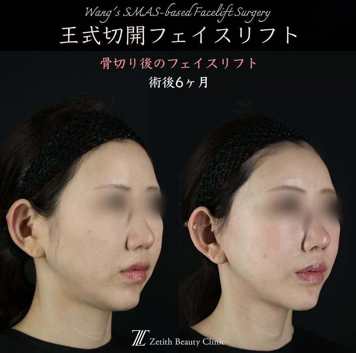 フェイスリフトのビフォーアフター写真