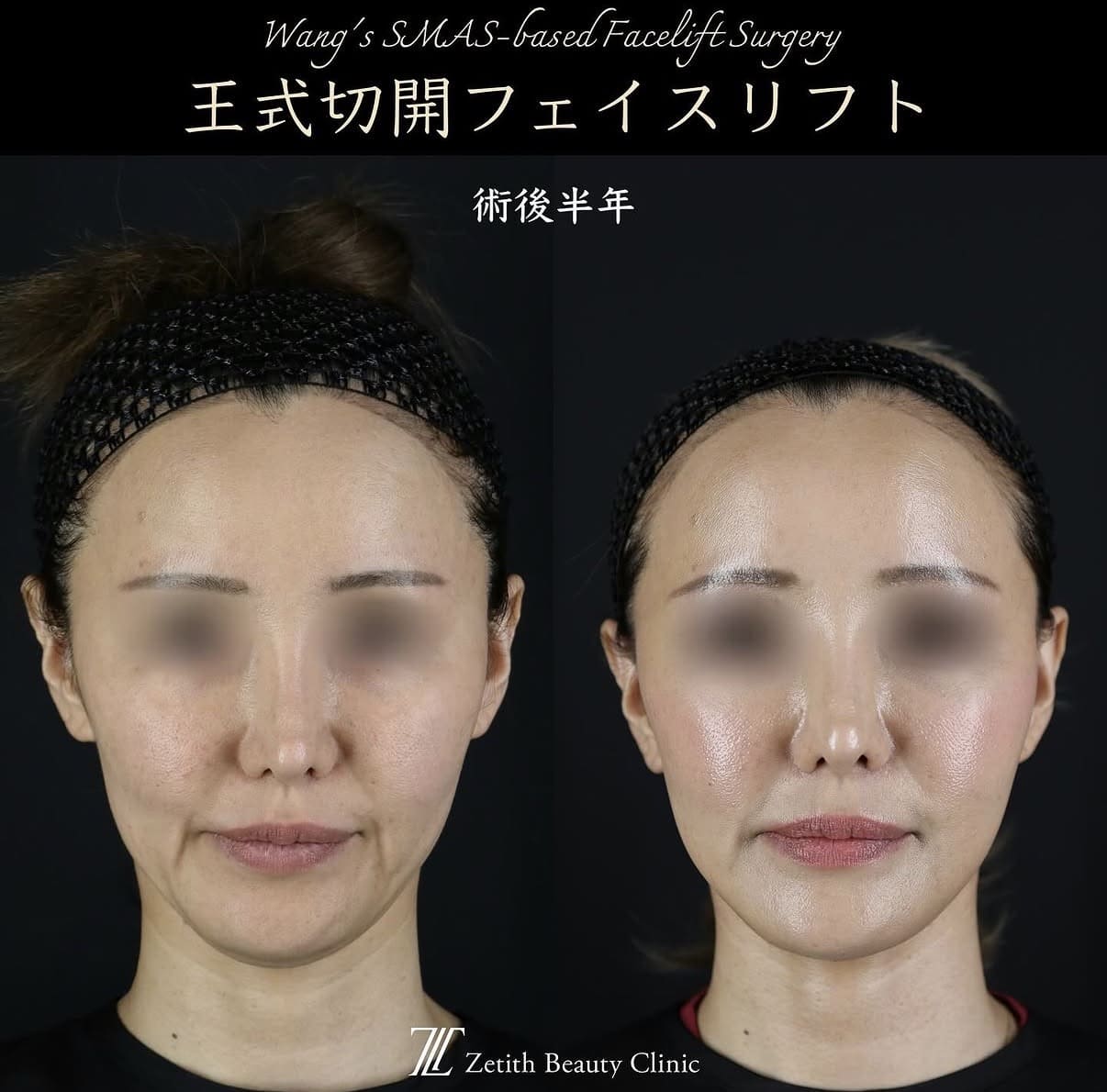 フェイスリフトのビフォーアフター写真