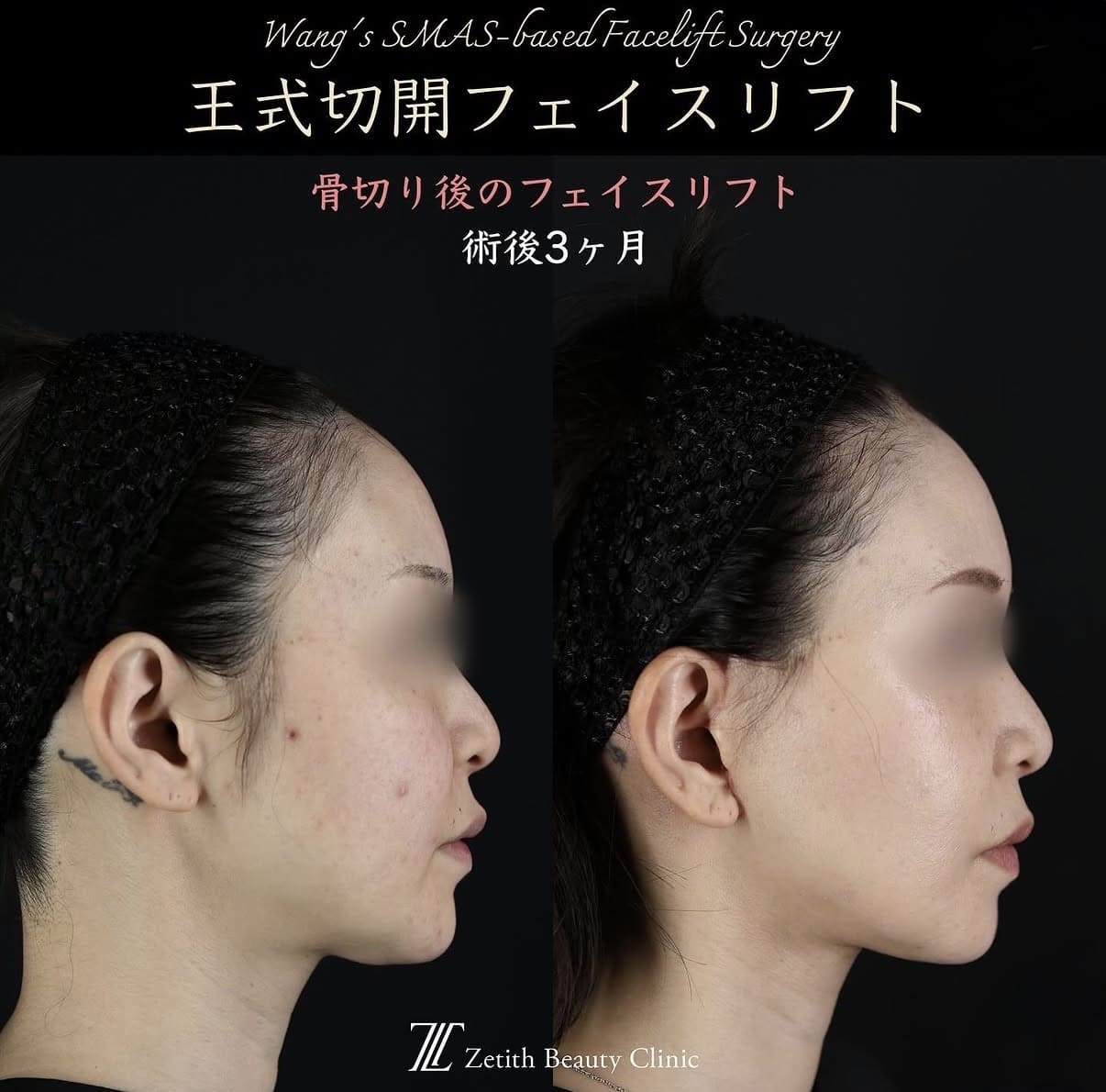 フェイスリフトのビフォーアフター写真