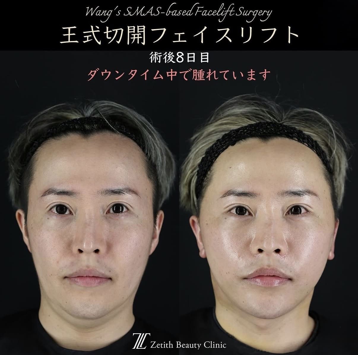フェイスリフトのビフォーアフター写真