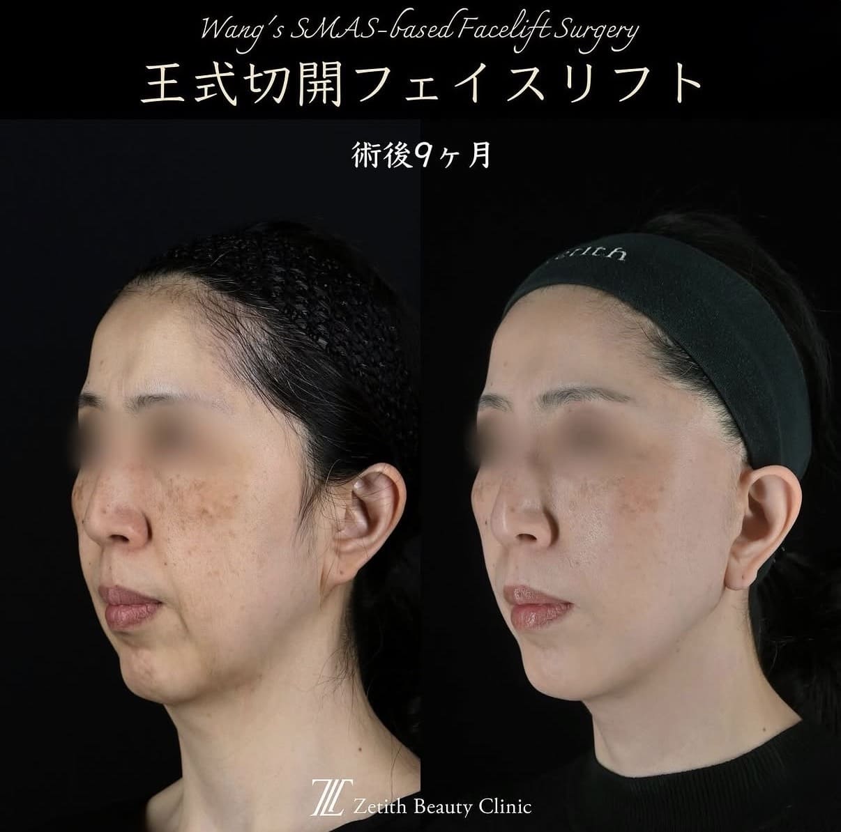 切開リフト - ゼティスビューティークリニック｜鼻整形・鼻形成、美肌