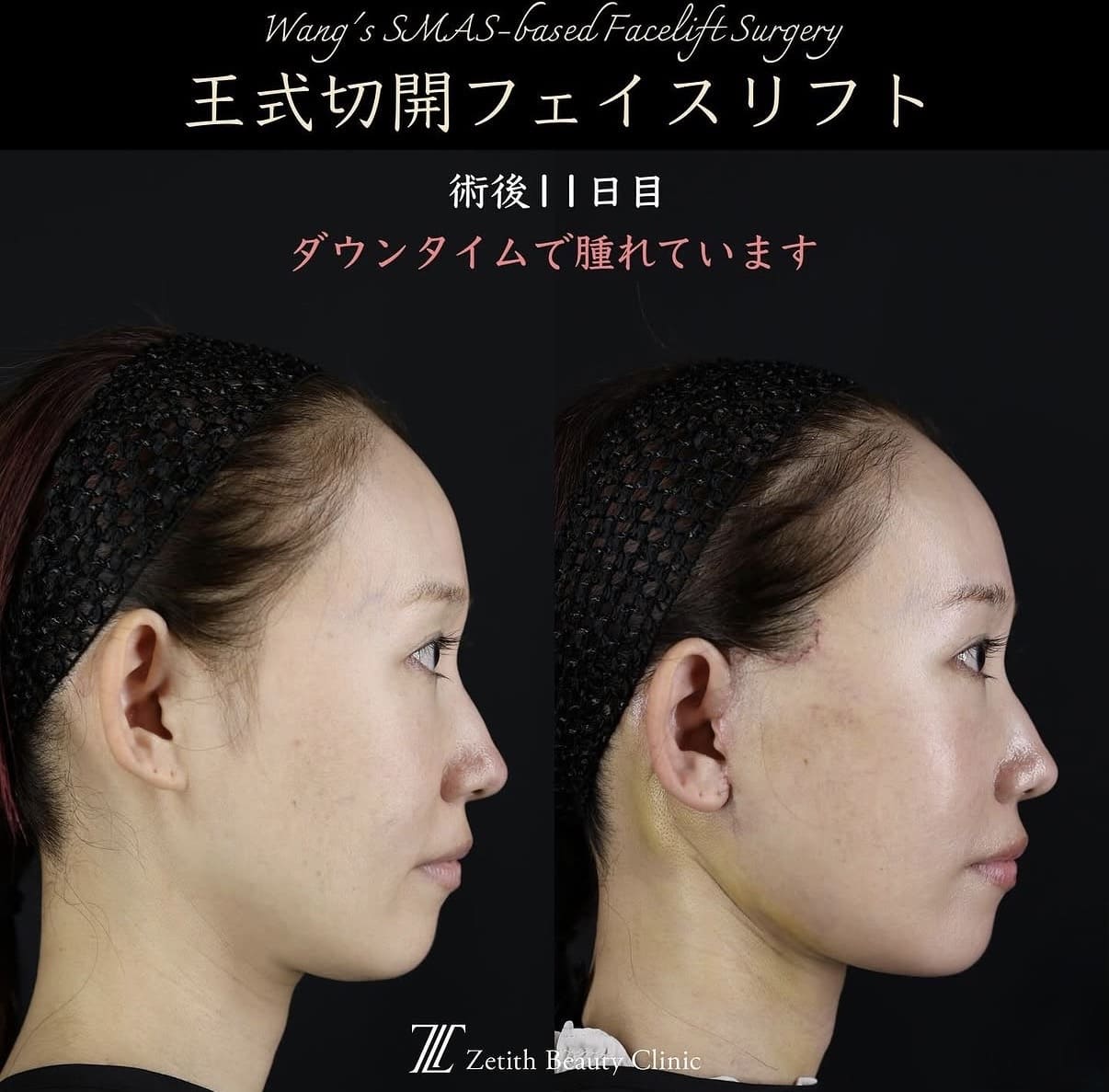 フェイスリフトのビフォーアフター写真