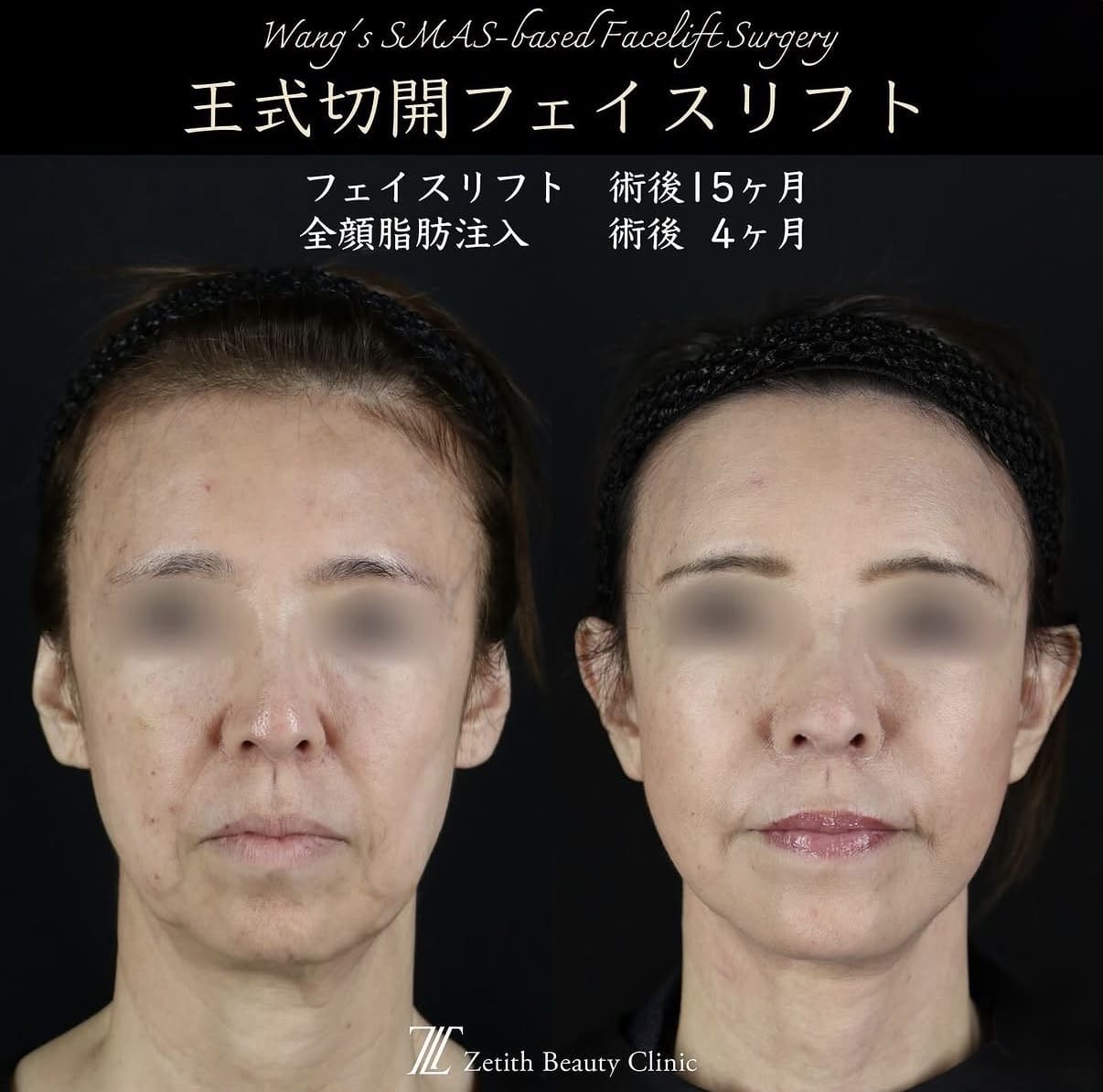 フェイスリフトのビフォーアフター写真