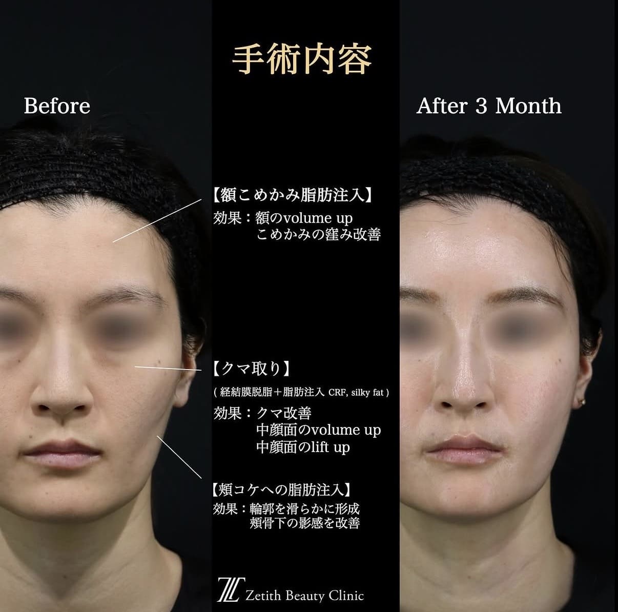 クマ取り、脂肪注入のビフォーアフター写真