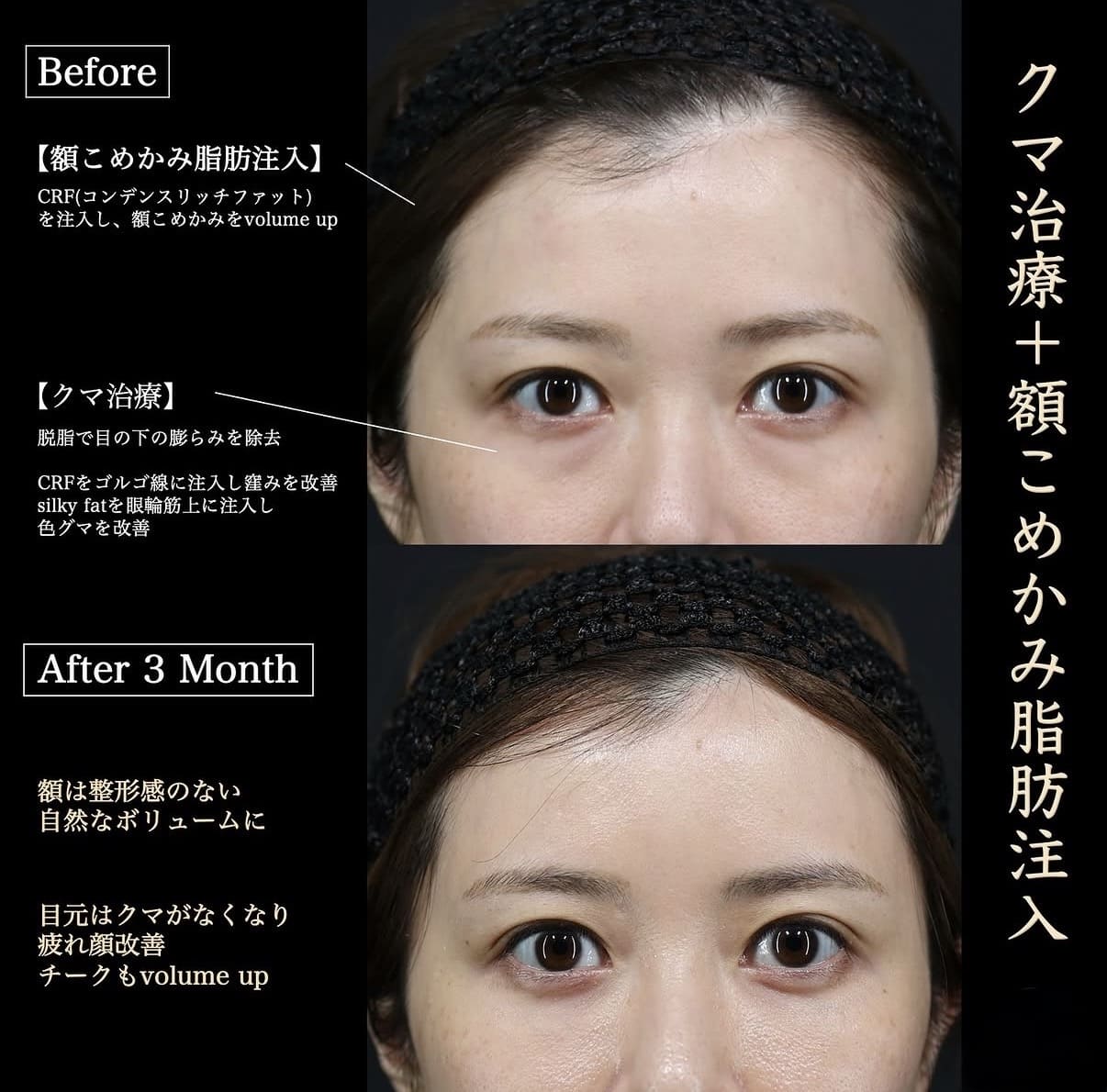クマ取り、脂肪注入のビフォーアフター写真
