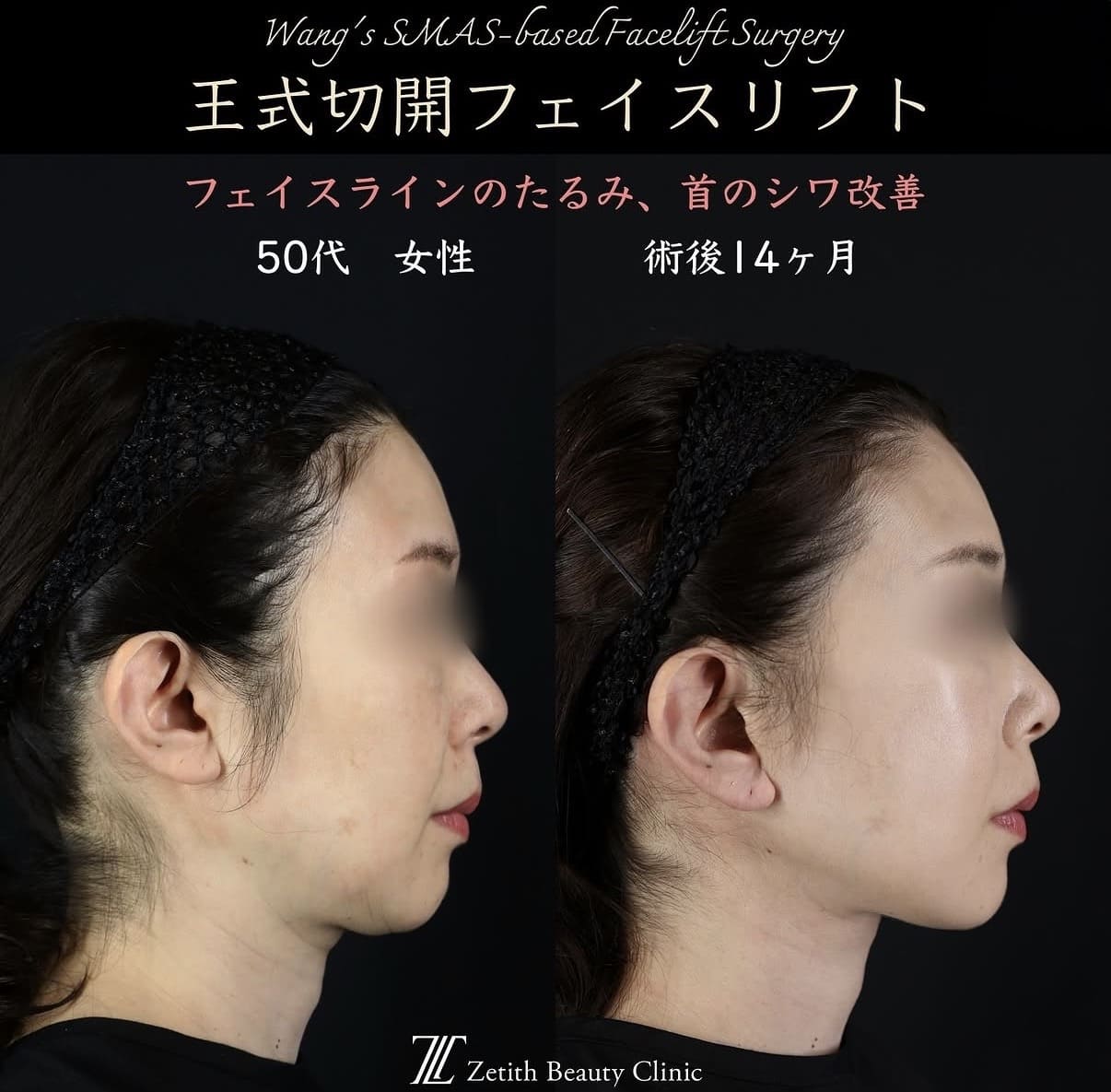 フェイスリフトのビフォーアフター写真