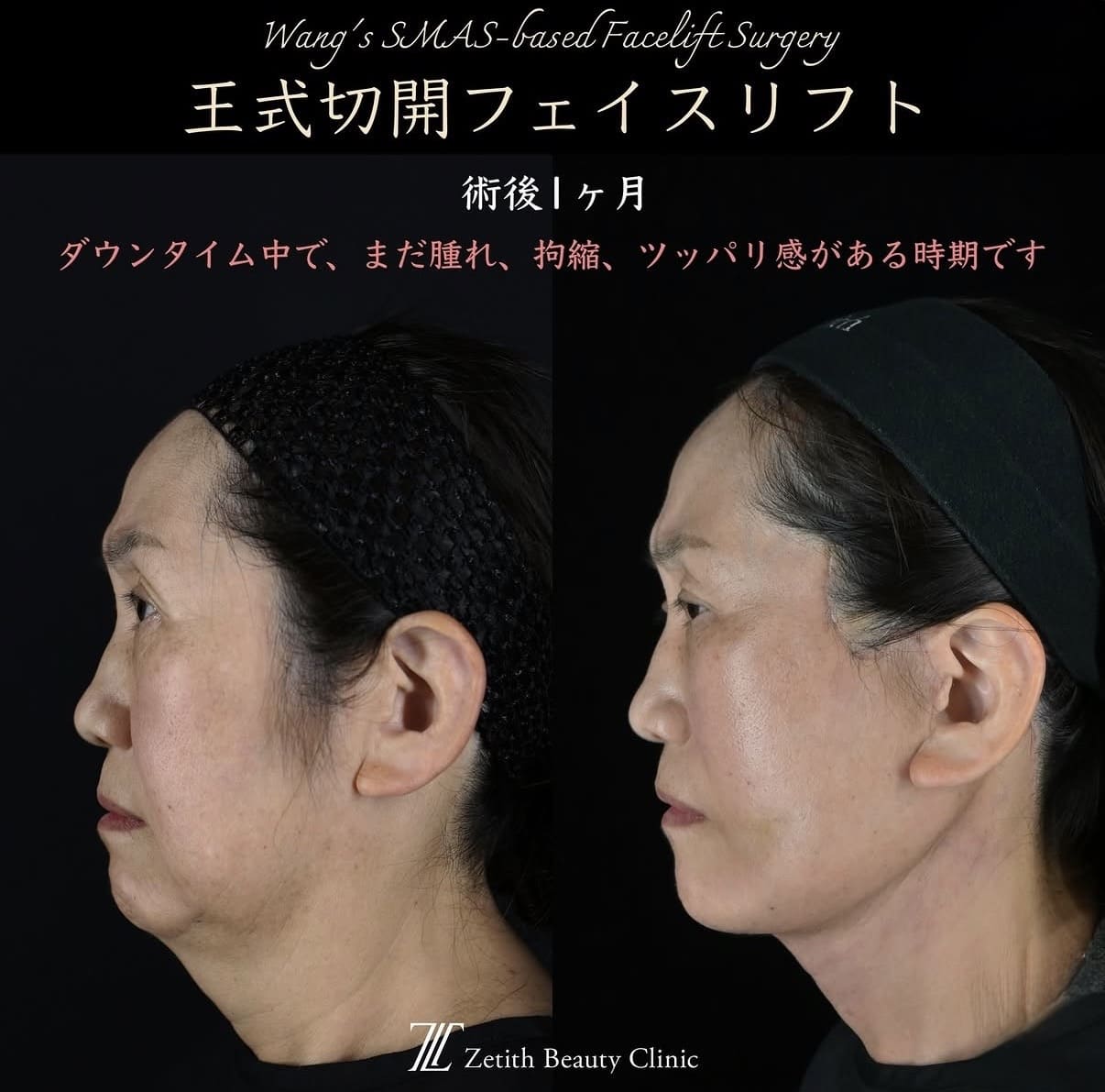 フェイスリフトのビフォーアフター写真