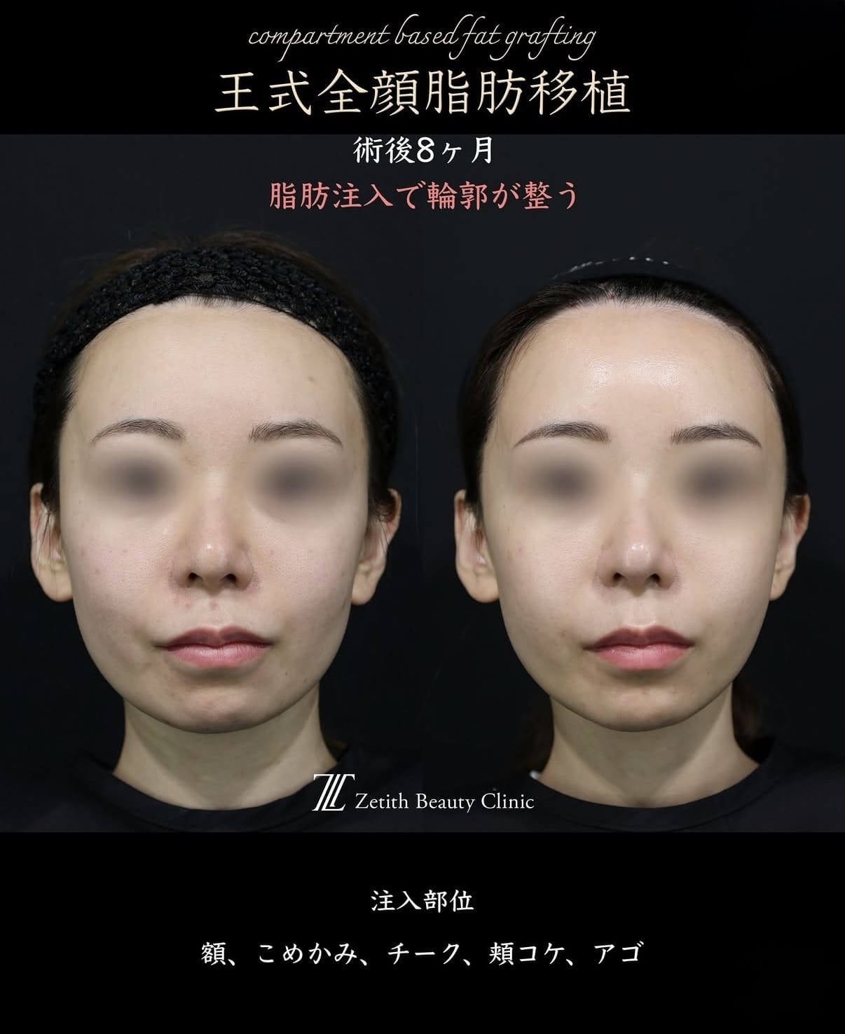 脂肪注入のビフォーアフター写真
