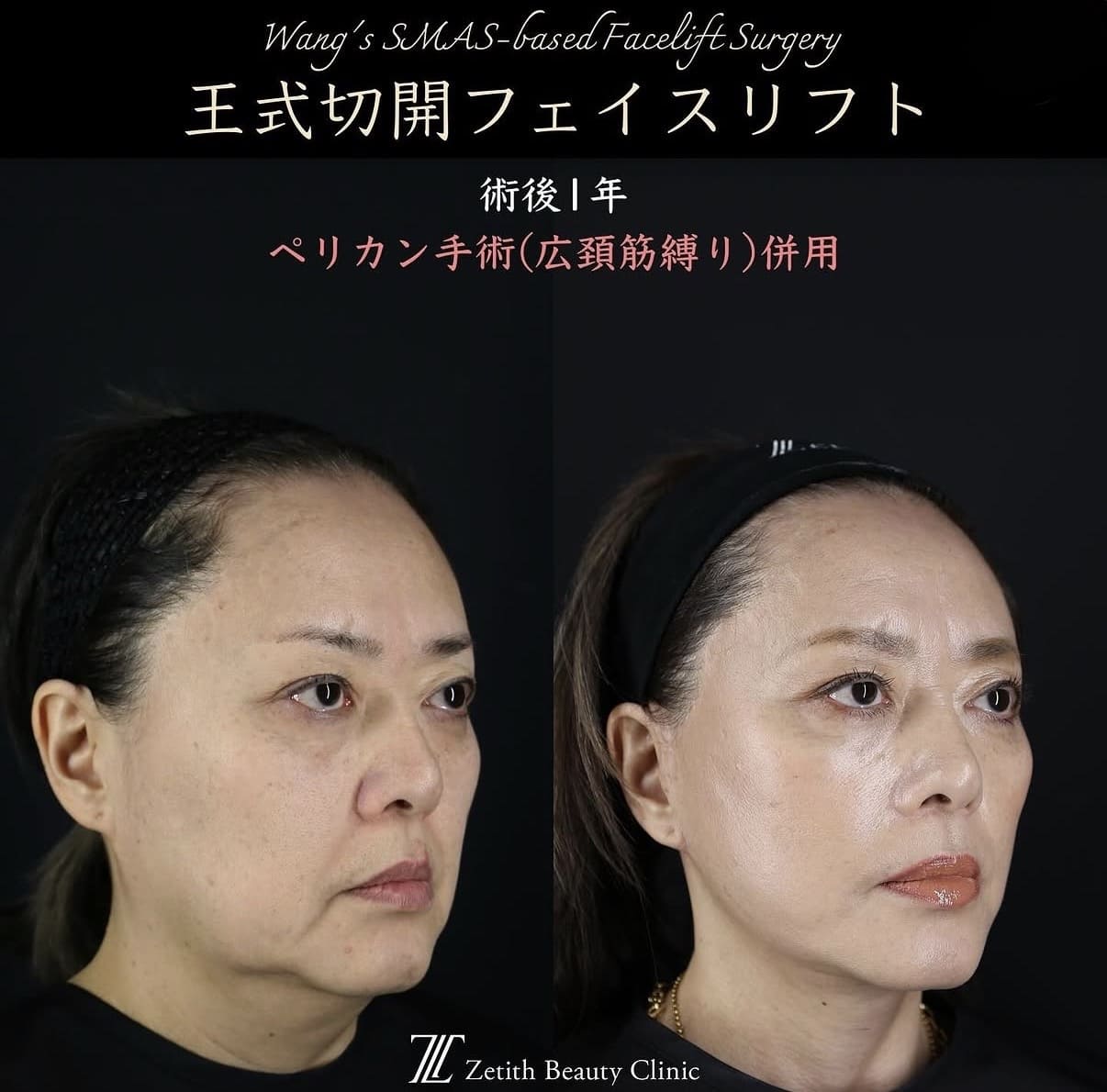 フェイスリフトのビフォーアフター写真