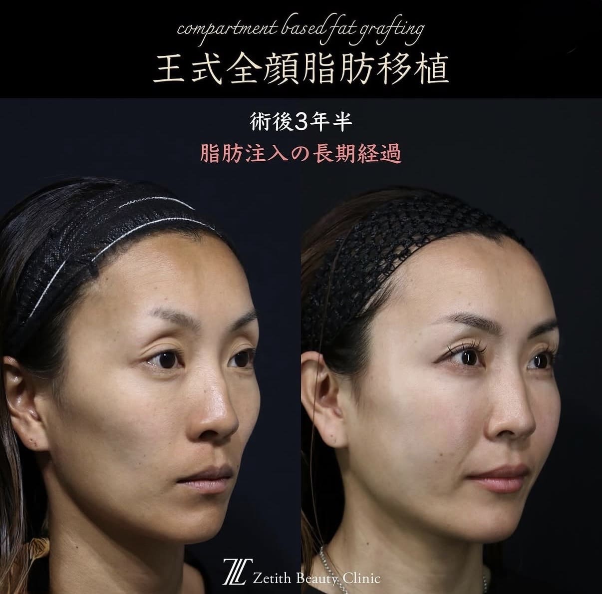 脂肪注入のビフォーアフター写真