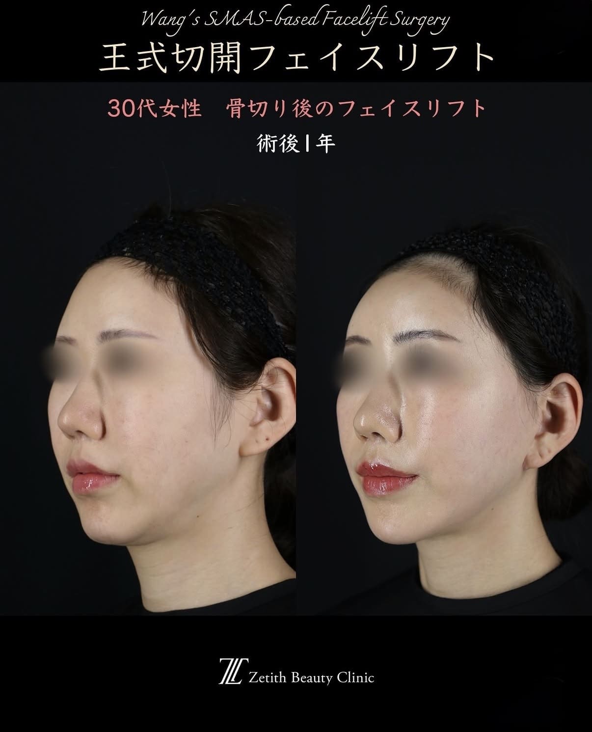 フェイスリフトのビフォーアフター写真