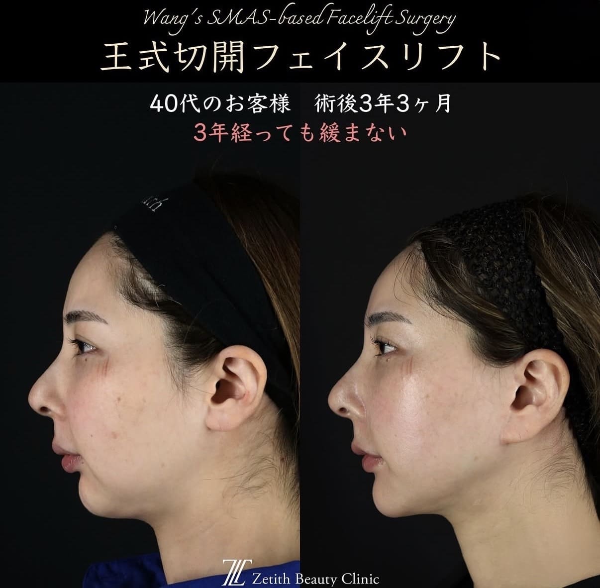 フェイスリフトのビフォーアフター写真