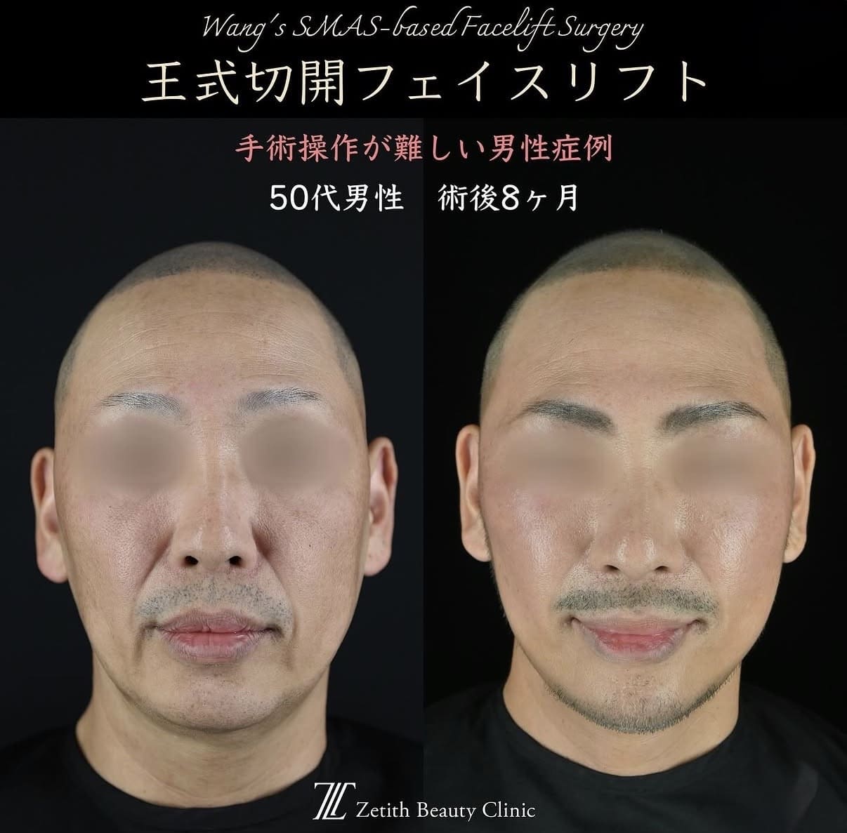 フェイスリフトのビフォーアフター写真