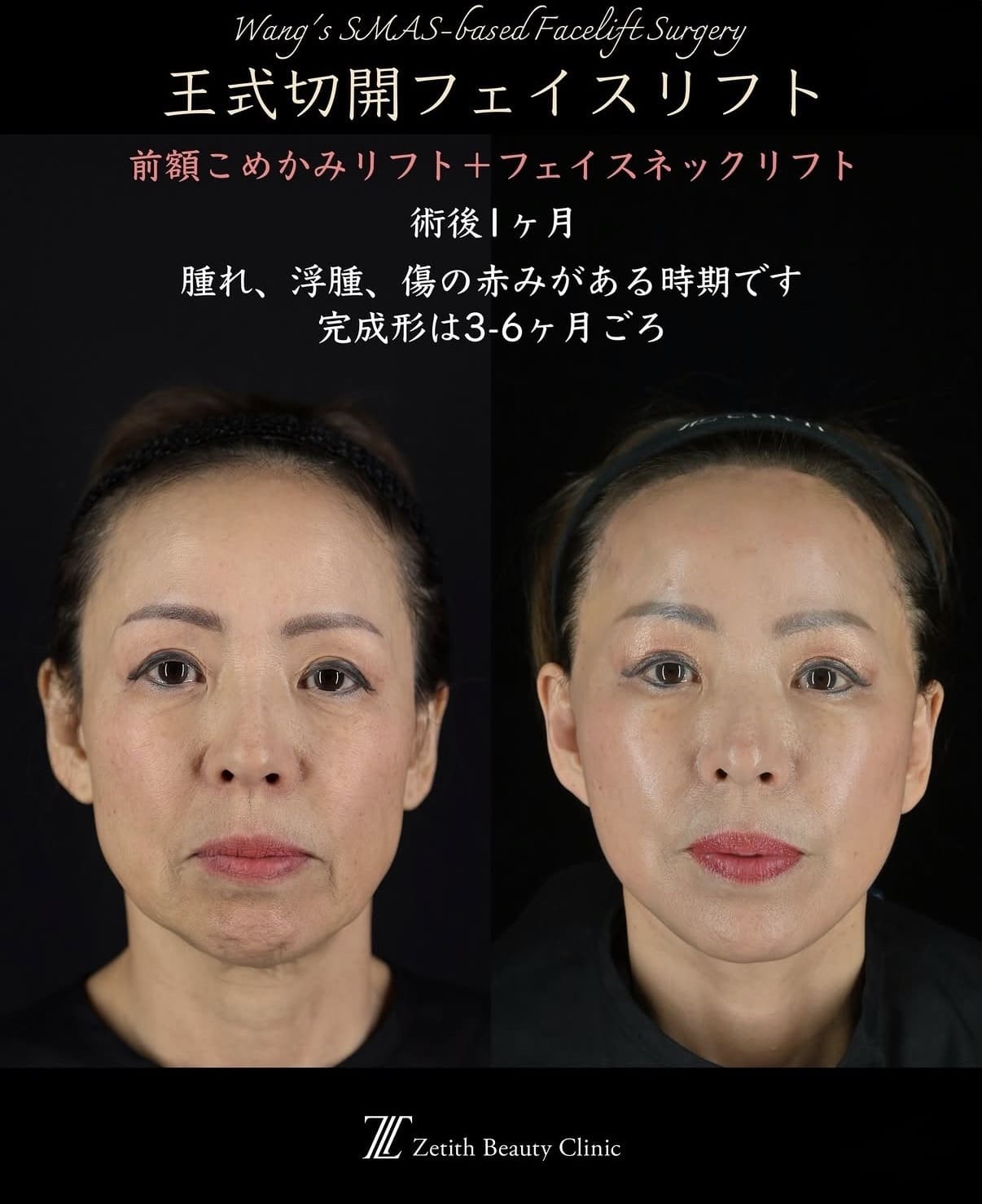 フェイスリフトのビフォーアフター写真