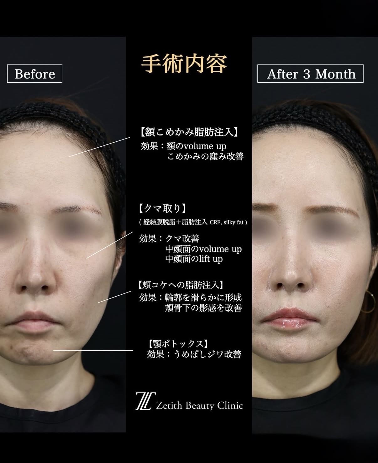 クマ取り、脂肪注入、ボトックス注入のビフォーアフター写真