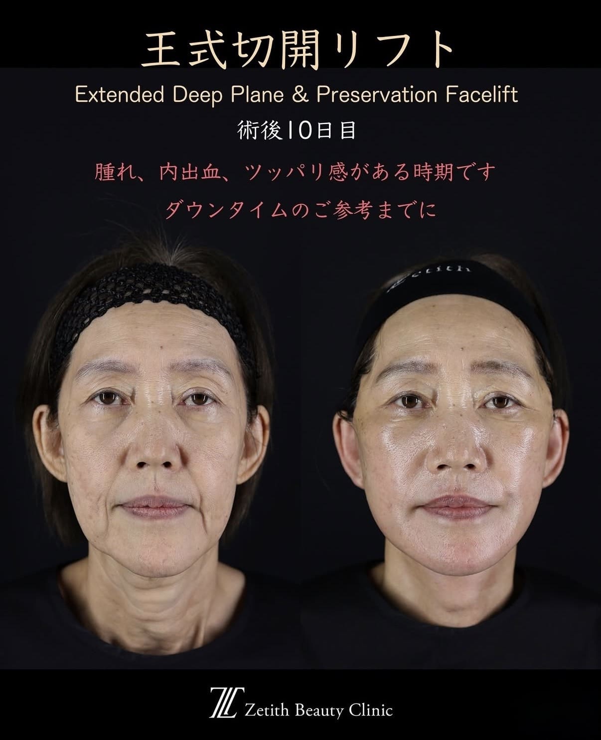 フェイスリフトのビフォーアフター写真