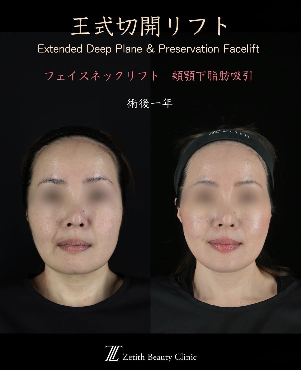 フェイスリフトのビフォーアフター写真