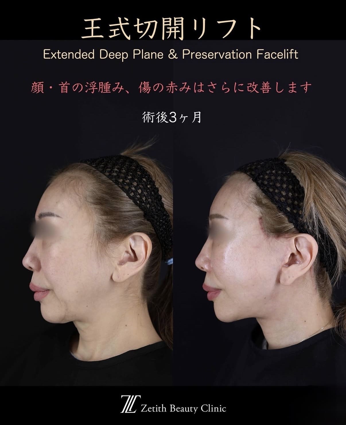 フェイスリフトのビフォーアフター写真