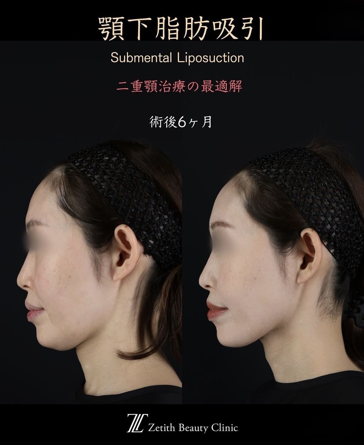 脂肪吸引のビフォーアフター