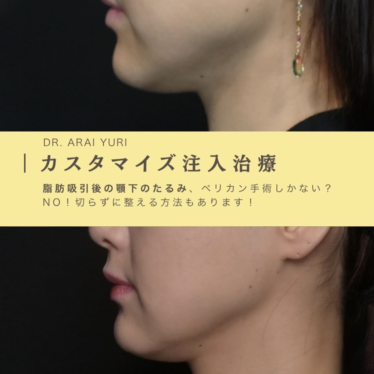 ボトックスリフトのビフォーアフター写真