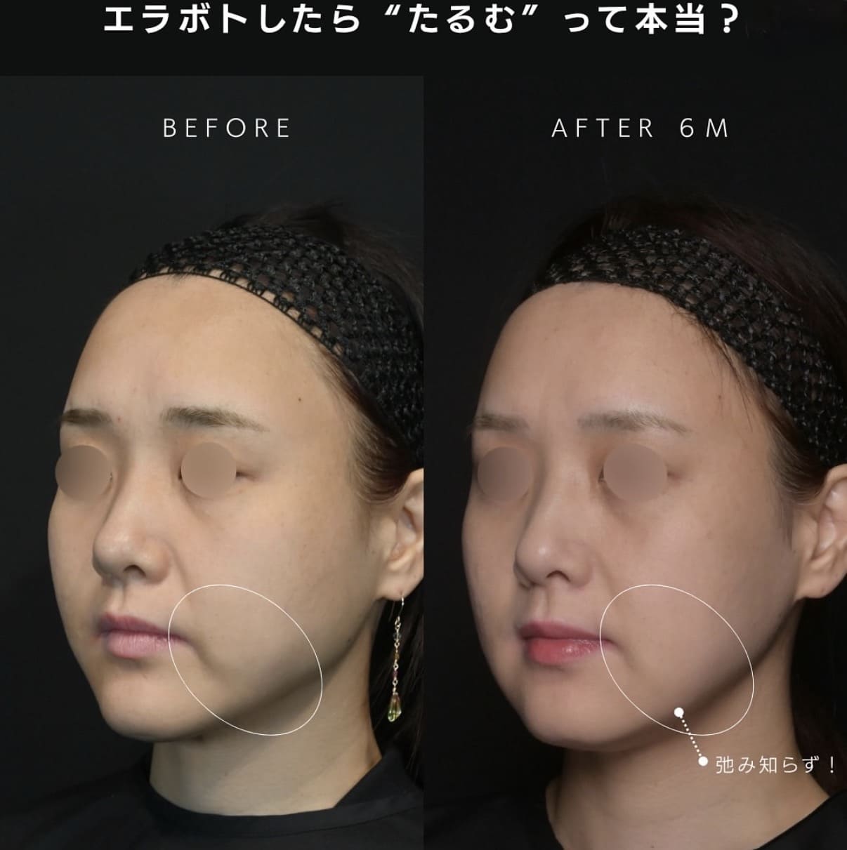 エラボトックスのビフォーアフター写真
