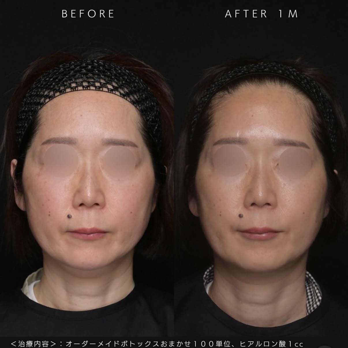 ボトックス・ヒアルロン酸注入のビフォーアフター写真