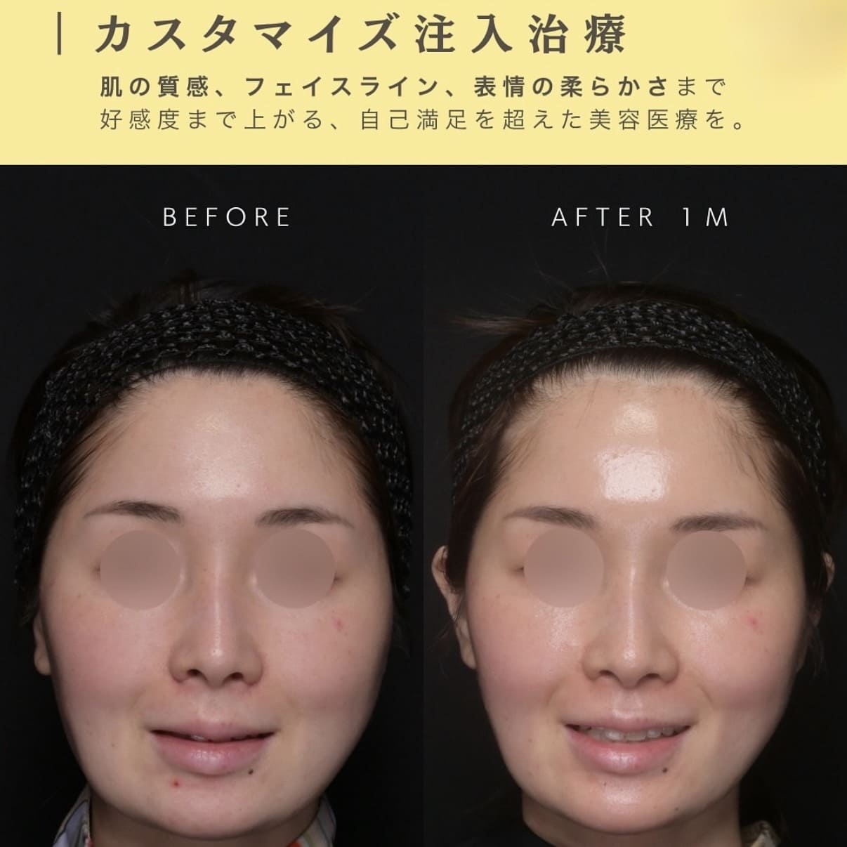 ボトックス注入・ショッピングリフトのビフォーアフター写真