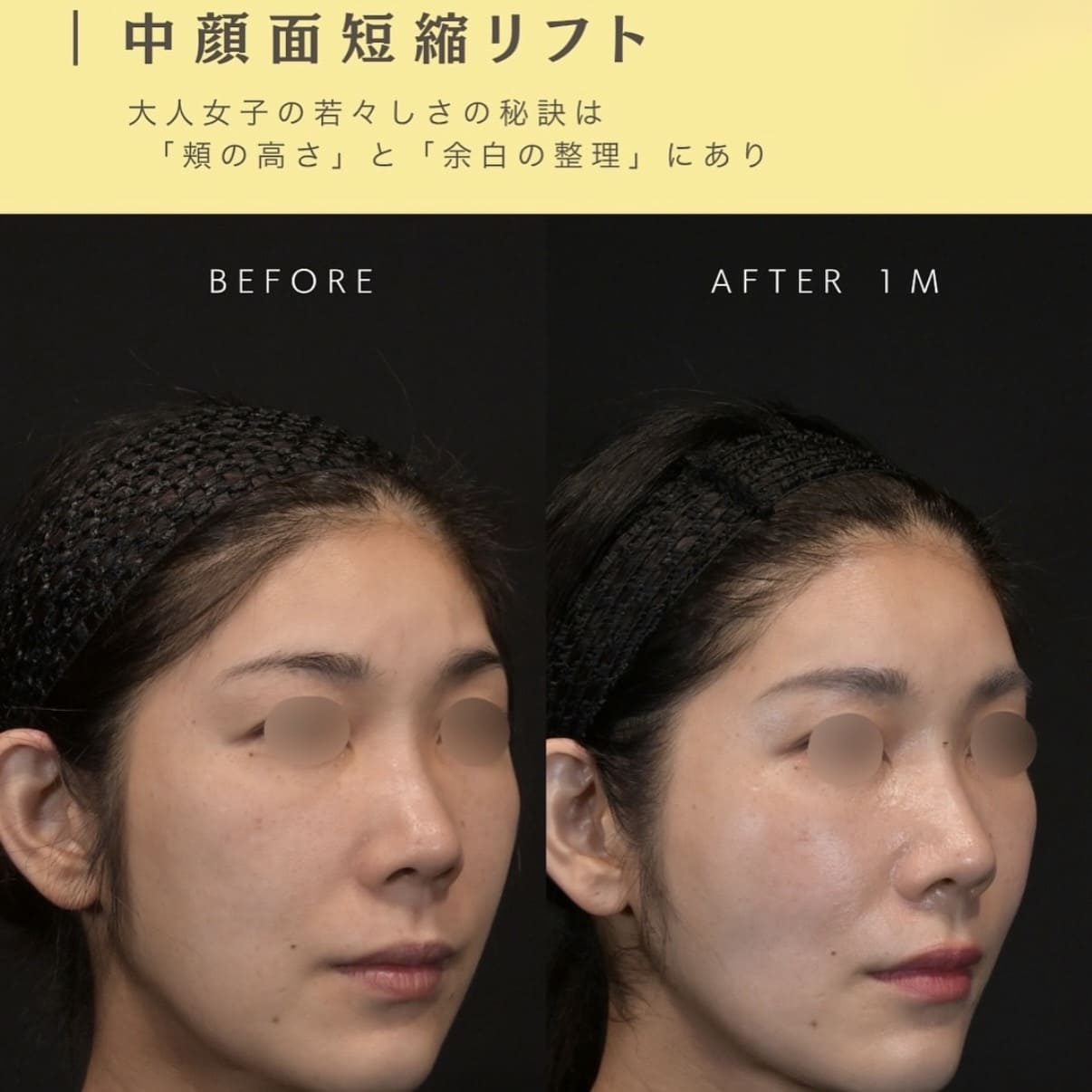 糸リフト・ヒアルロン酸注入のビフォーアフター写真