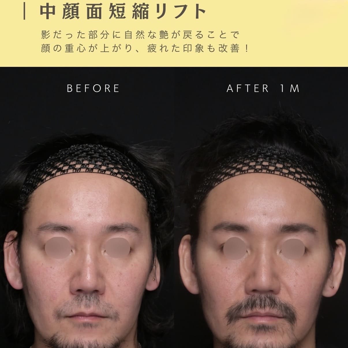 糸リフトのビフォーアフター写真