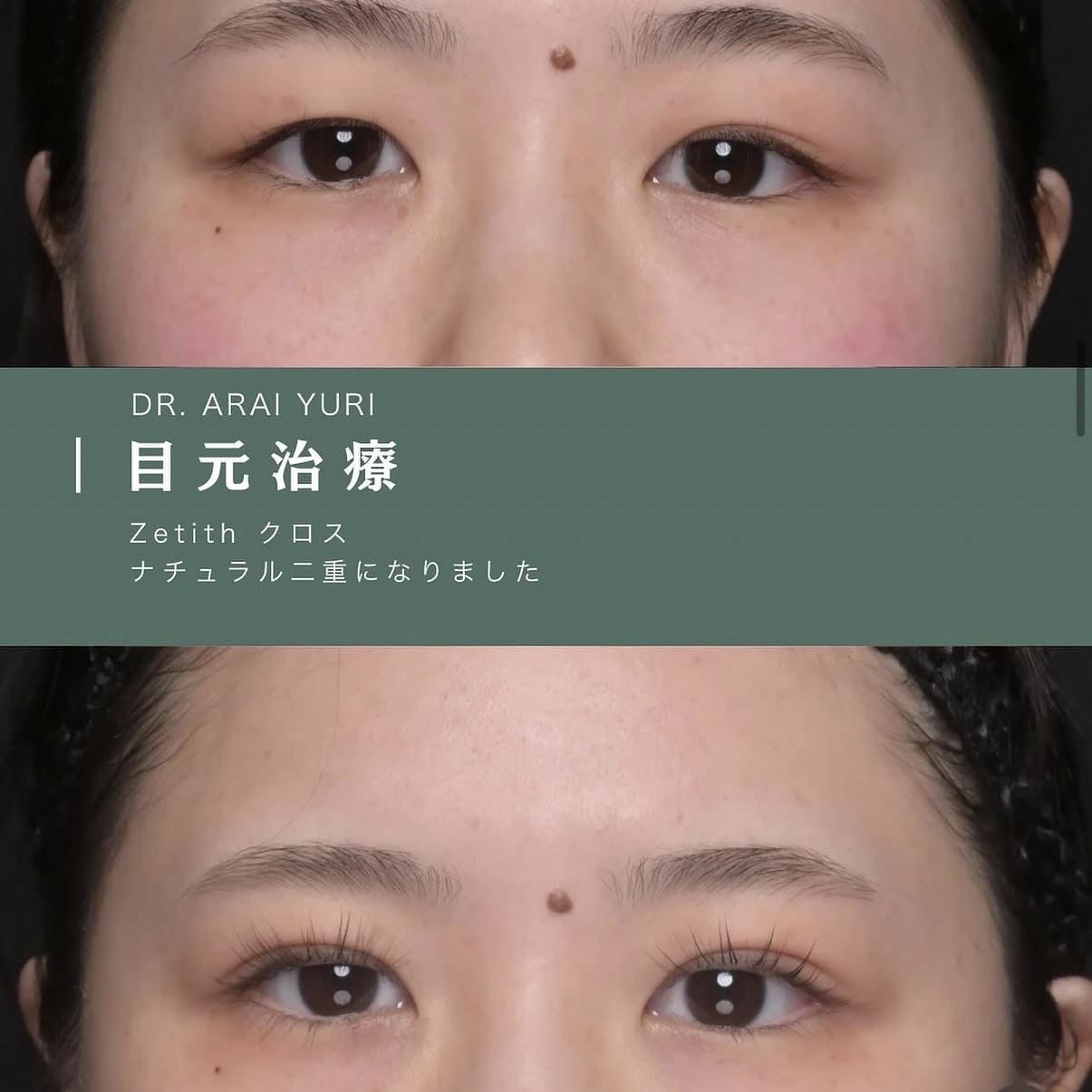 二重整形のビフォーアフター写真