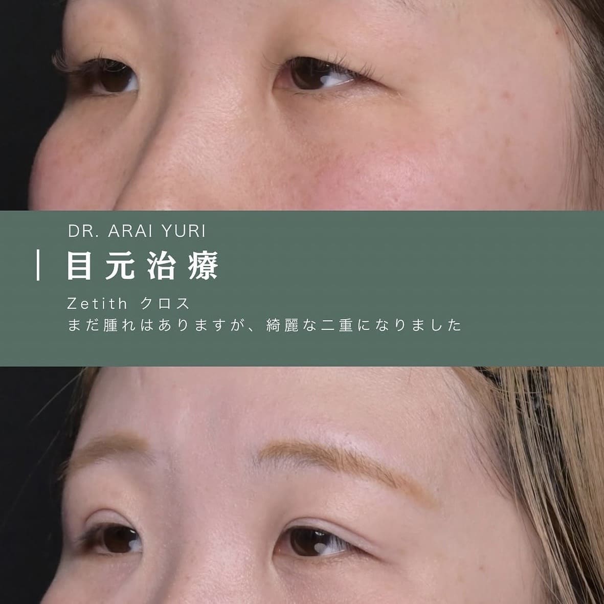 二重整形のビフォーアフター写真