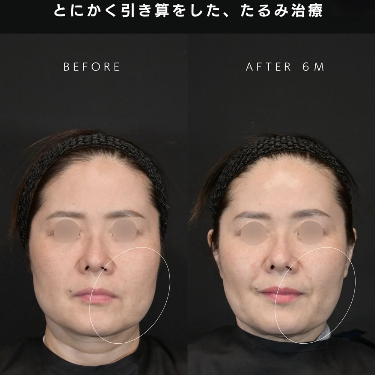 ボトックス注入・HIFU・脂肪溶解注射のビフォーアフター写真