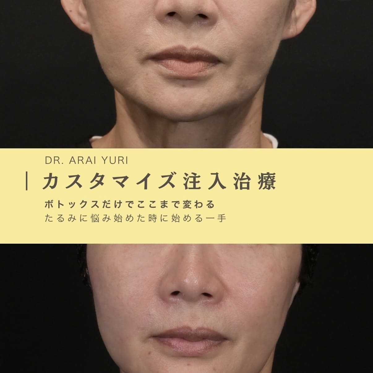 ボトックス注入のビフォーアフター写真