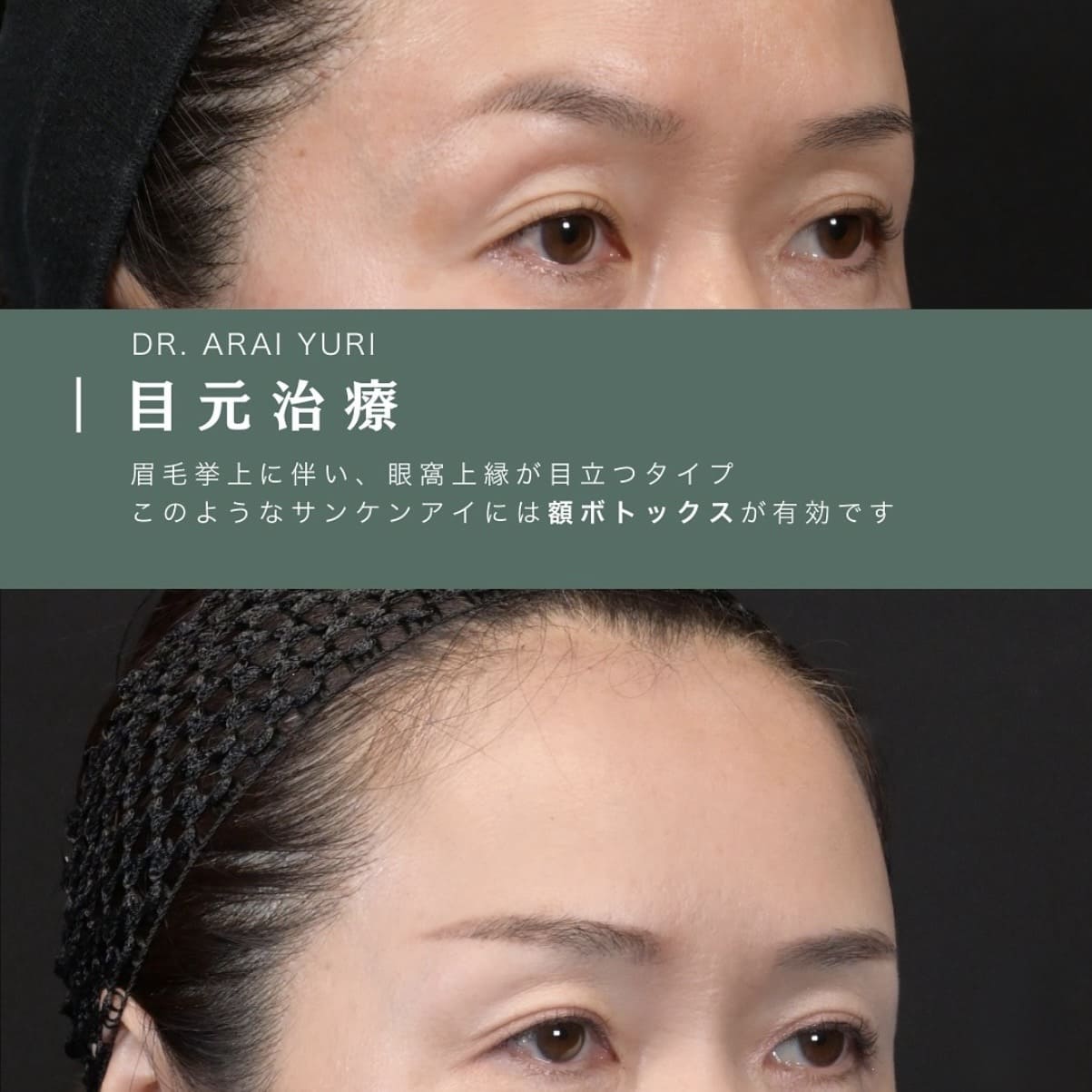 ボトックス注入のビフォーアフター写真