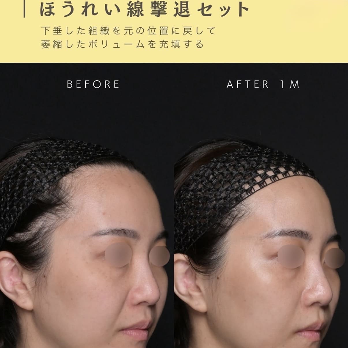 糸リフト・ヒアルロン酸注入のビフォーアフター写真