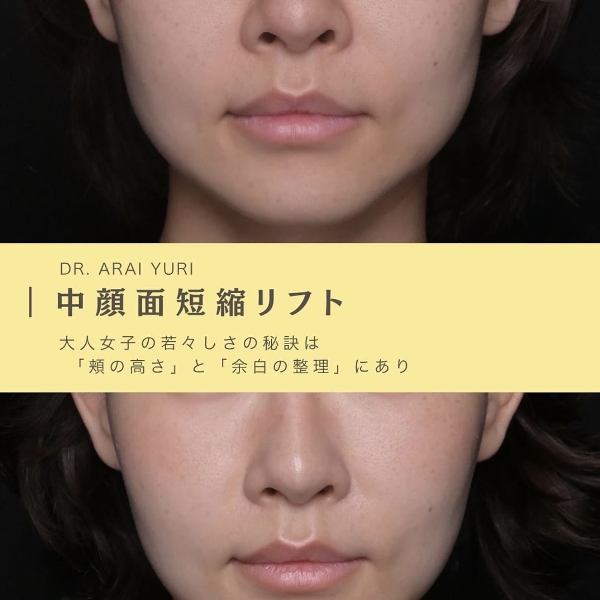 糸リフト・ボトックス注入・HIFUのビフォーアフター写真