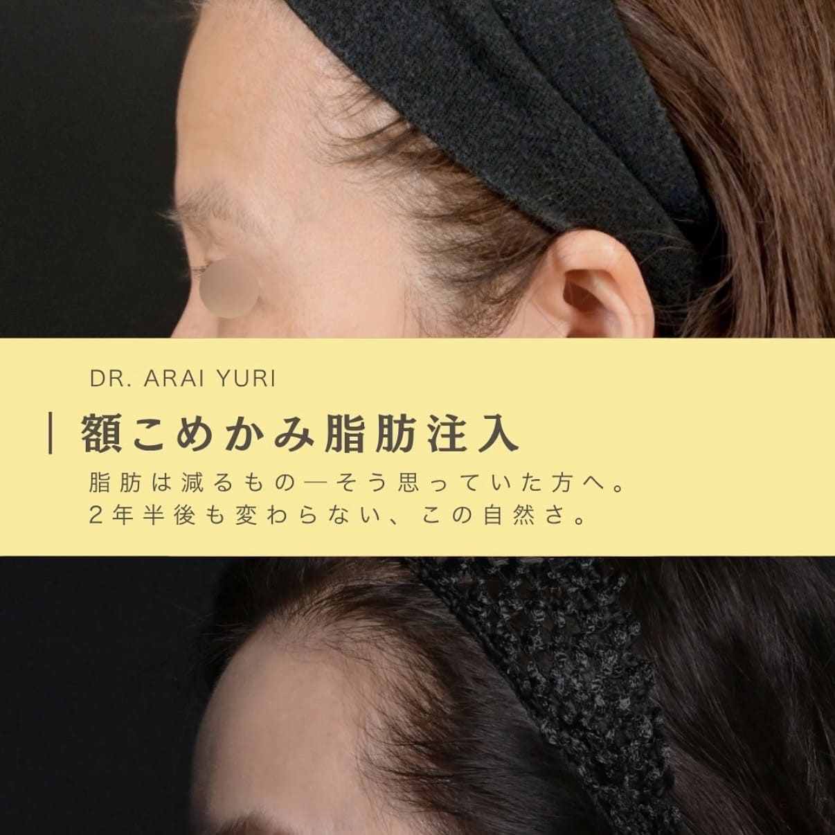 脂肪注入・ボトックス注入のビフォーアフター写真