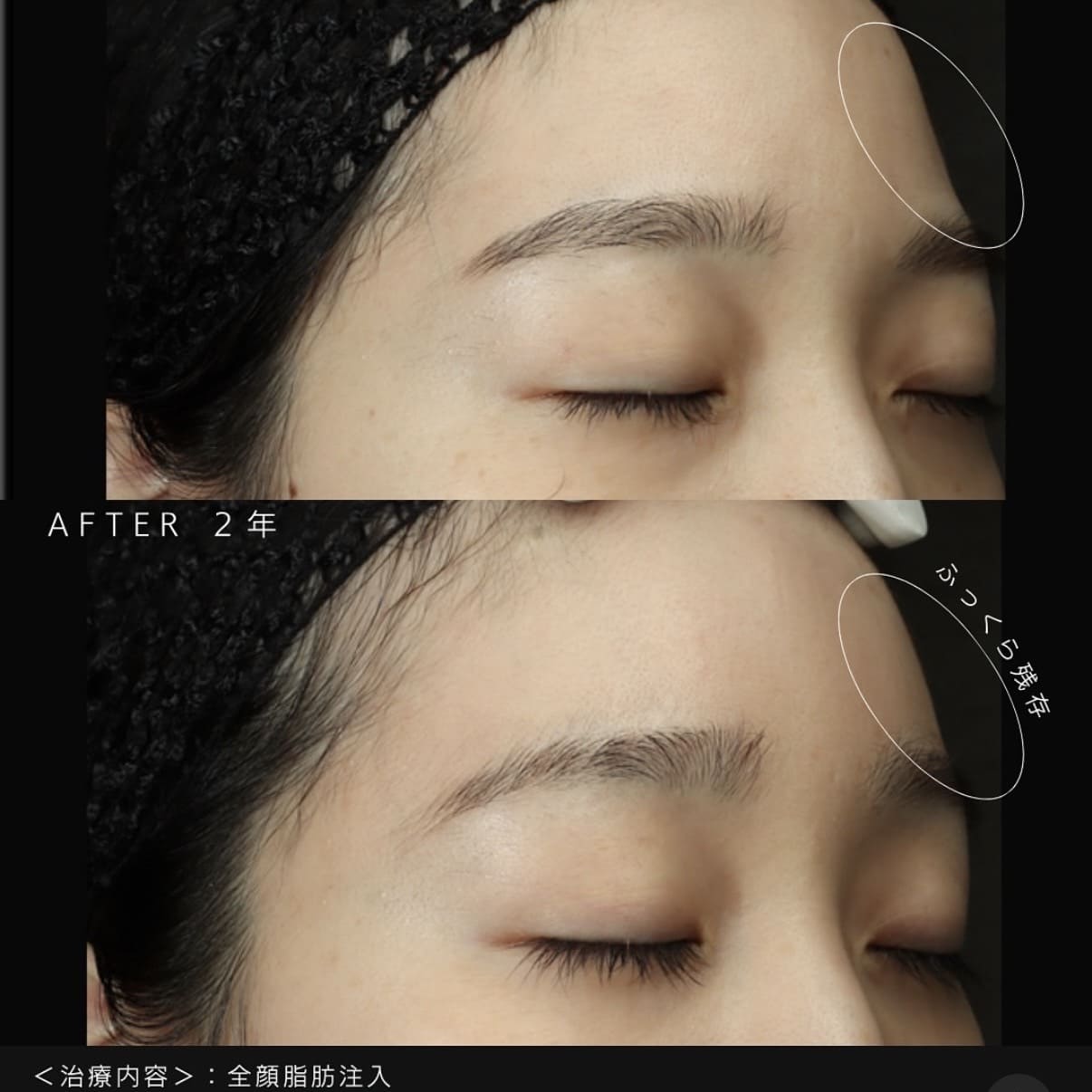 脂肪注入のビフォーアフター写真