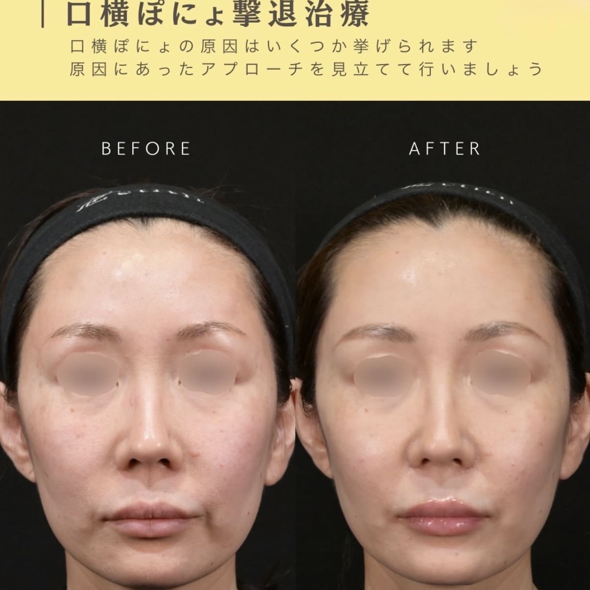 ショッピングリフトのビフォーアフター写真