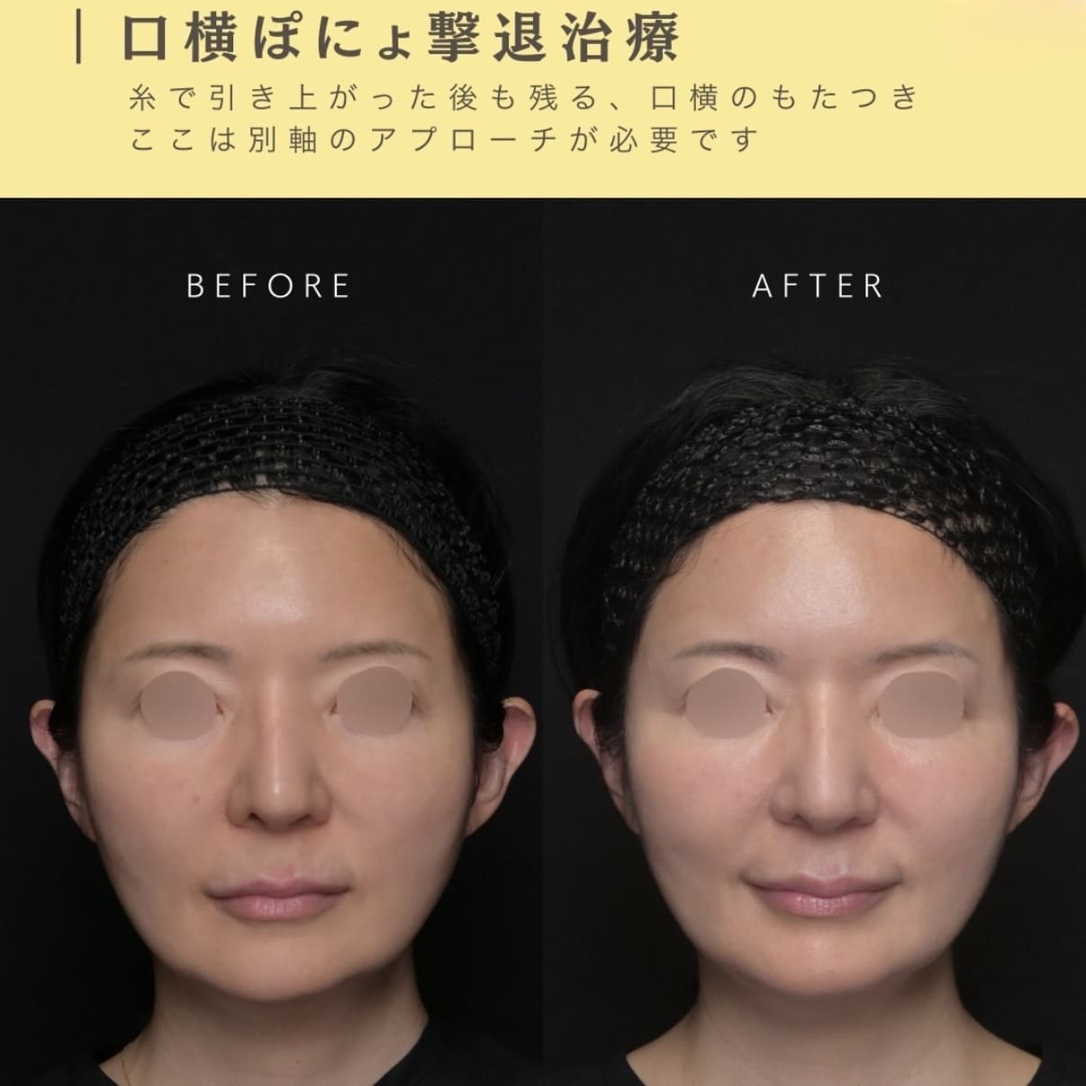 ショッピングリフト・脂肪溶解注射のビフォーアフター写真