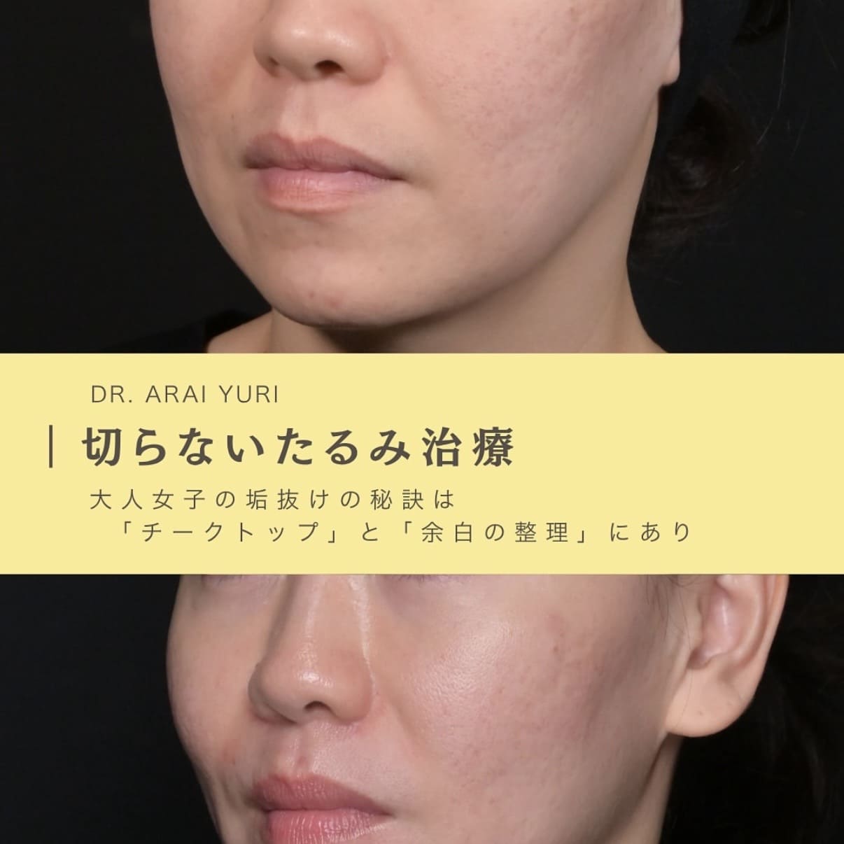 糸リフト・ボトックス注入・ヒアルロン酸注入のビフォーアフター写真