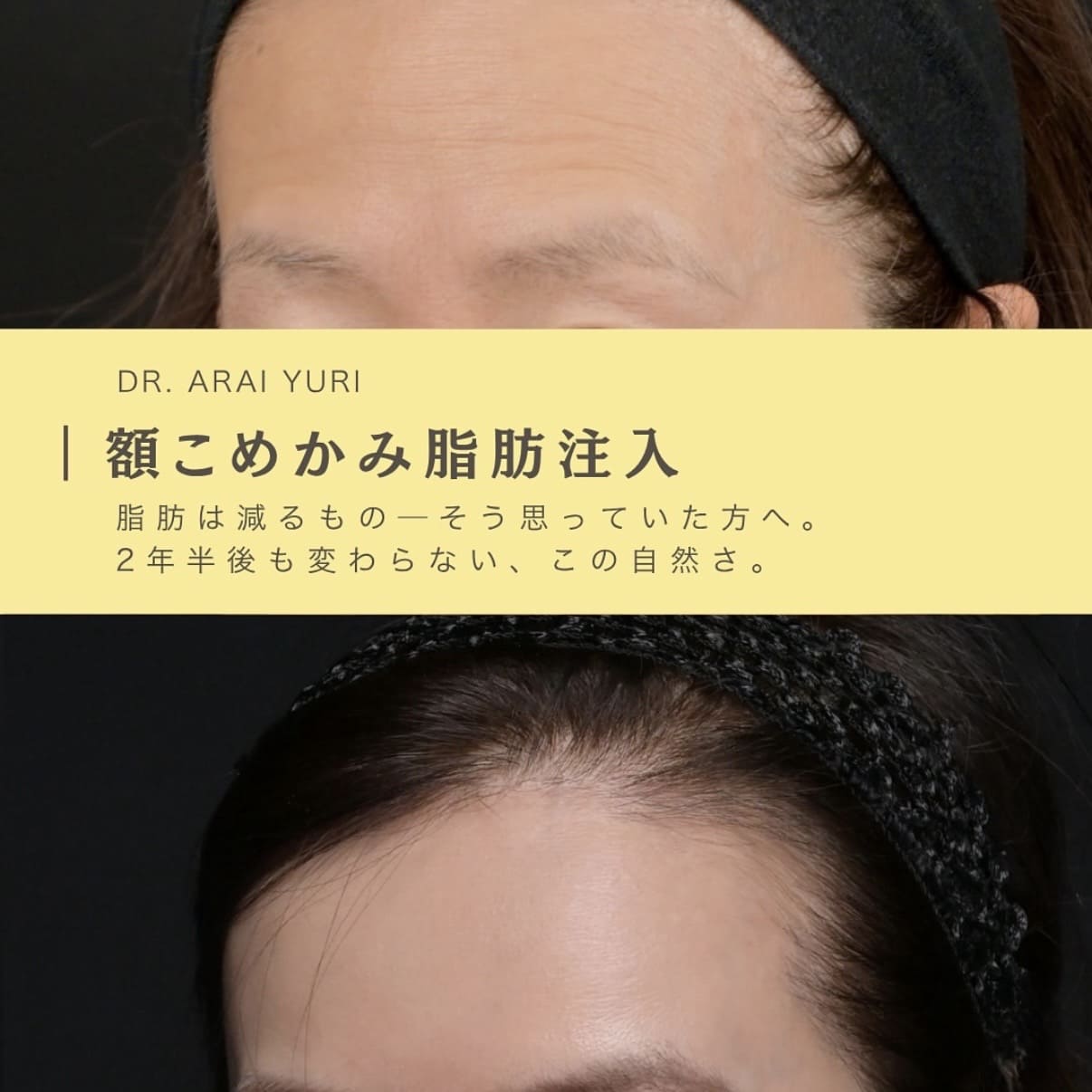 脂肪注入・ボトックスのビフォーアフター写真