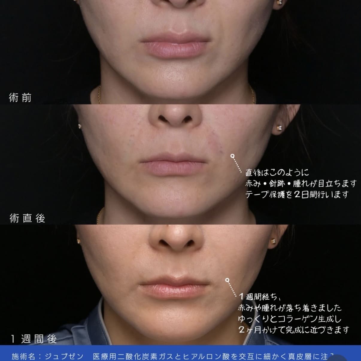 ジュブゼンのビフォーアフター写真