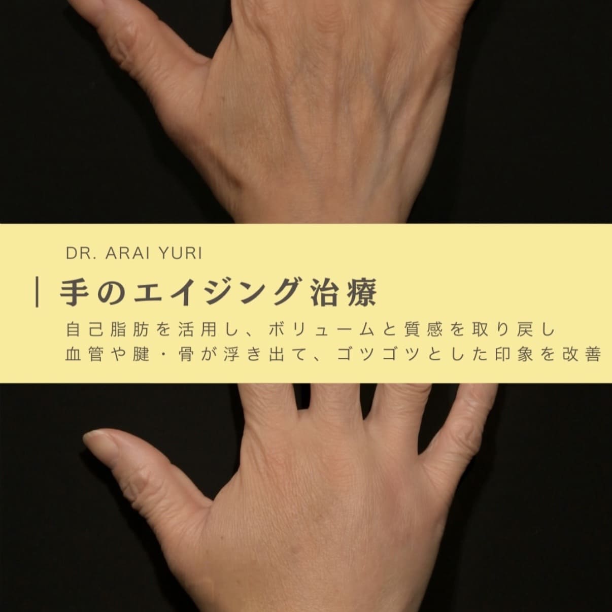 脂肪注入のビフォーアフター写真