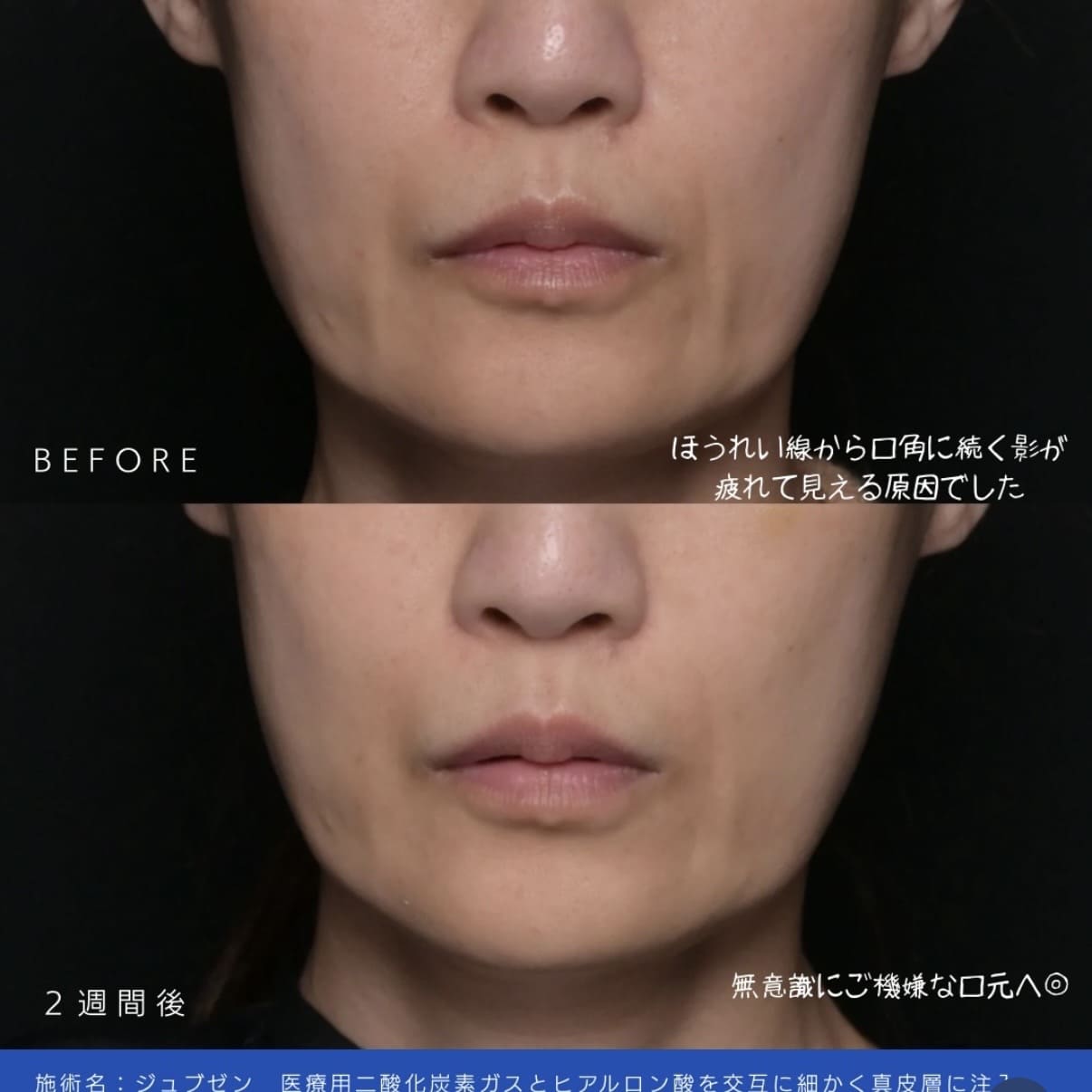 ジュブゼンのビフォーアフター写真