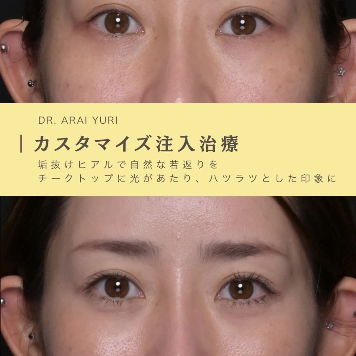 ヒアルロン酸注入のビフォーアフター写真